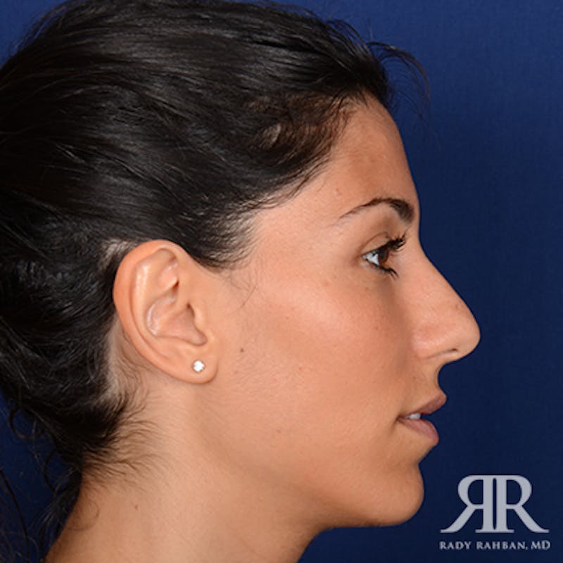 Ethnic Rhinoplasty Before & After Gallery - Patient 238809 - Image 5