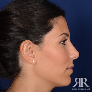 Ethnic Rhinoplasty Before & After Gallery - Patient 238809 - Image 6