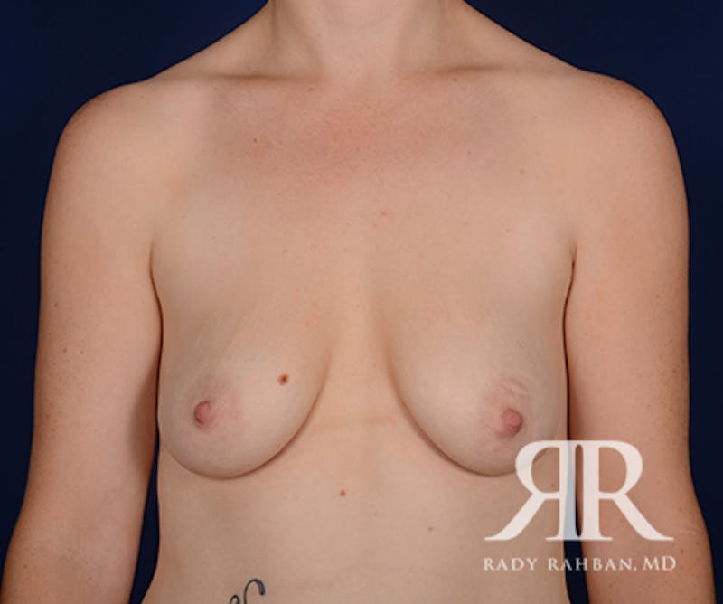 Breast Lift Before & After Gallery - Patient 236708 - Image 1
