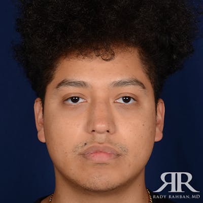 Rhinoplasty w/ Chin Implant Before & After Gallery - Patient 407808 - Image 2