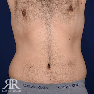 Body Lift Before & After Gallery - Patient 190939 - Image 2