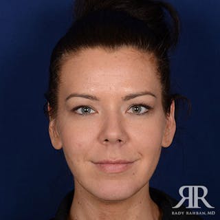 Chin Augmentation Before & After Gallery - Patient 319399 - Image 2