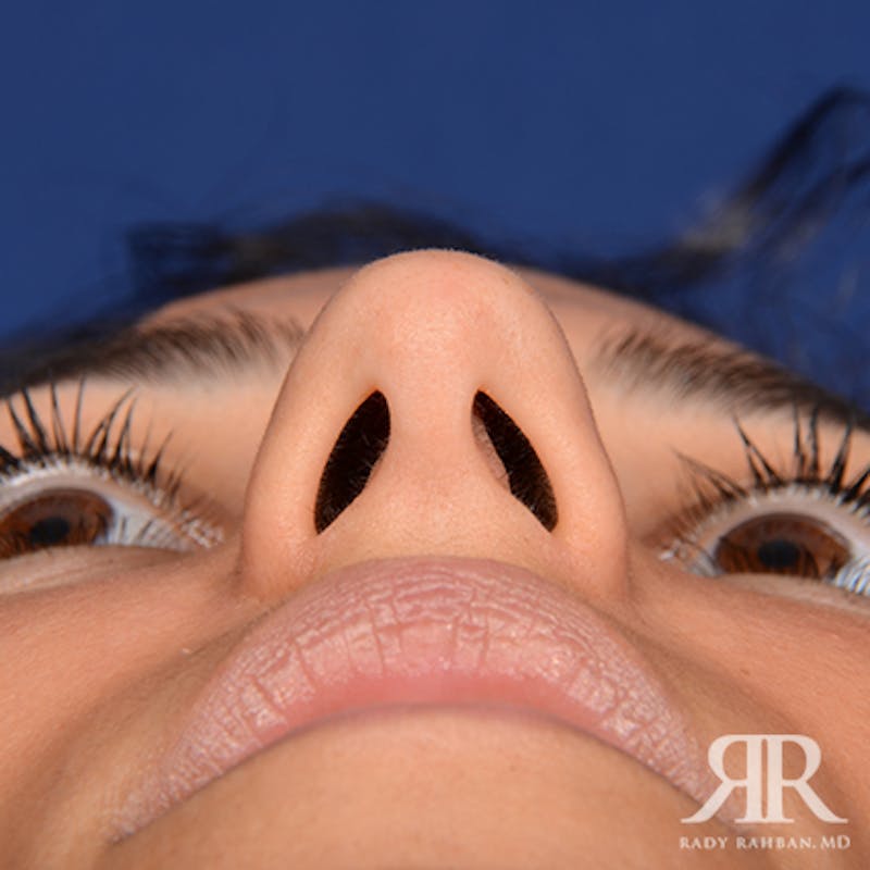 Ethnic Rhinoplasty Before & After Gallery - Patient 238809 - Image 7