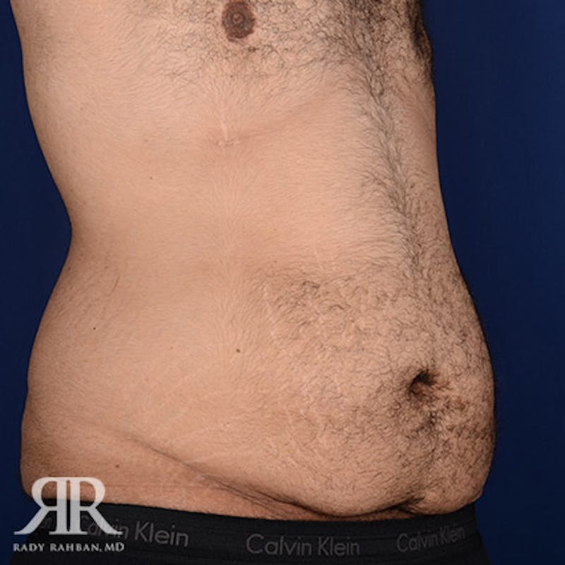 Body Lift Before & After Gallery - Patient 190939 - Image 3
