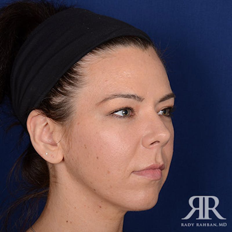 Chin Augmentation Before & After Gallery - Patient 319399 - Image 3