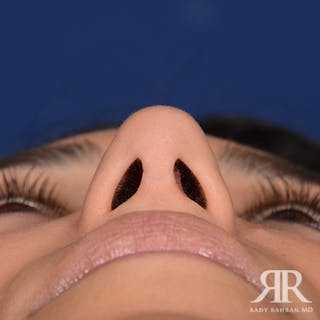 Ethnic Rhinoplasty Before & After Gallery - Patient 238809 - Image 8