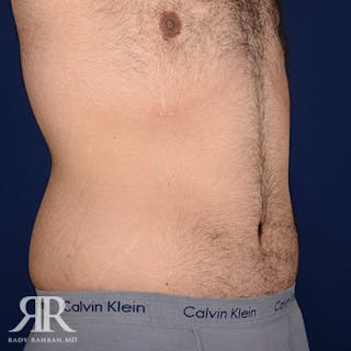 Body Lift Before & After Gallery - Patient 190939 - Image 4