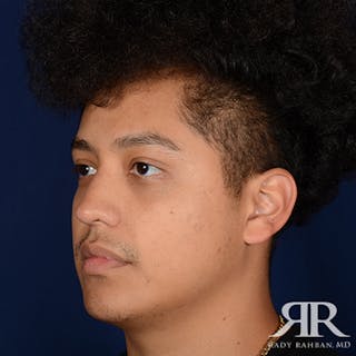 Rhinoplasty w/ Chin Implant Before & After Gallery - Patient 407808 - Image 4