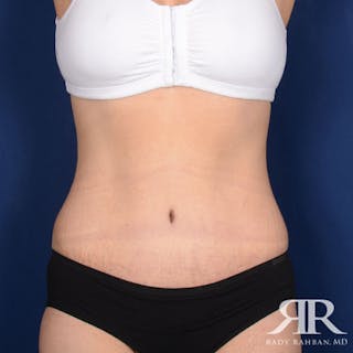 Tummy Tuck Before & After Gallery - Patient 209616 - Image 2