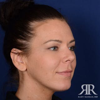 Chin Augmentation Before & After Gallery - Patient 319399 - Image 4