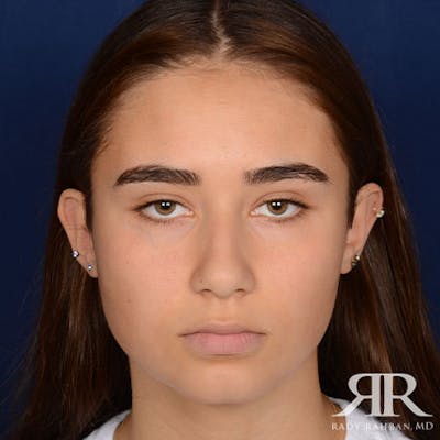 Female Rhinoplasty Before & After Gallery - Patient 350819 - Image 1