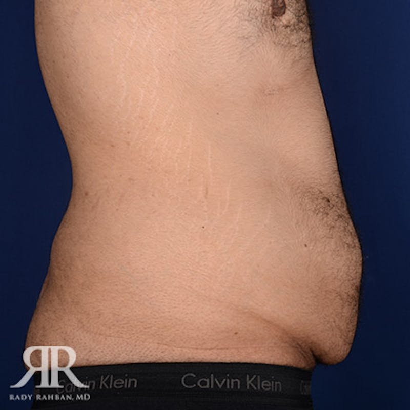 Body Lift Before & After Gallery - Patient 190939 - Image 5