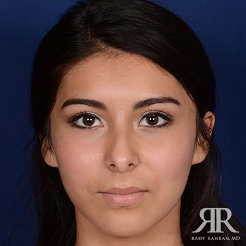 Ethnic Rhinoplasty Before & After Gallery - Patient 365631 - Image 1