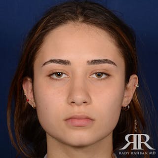 Female Rhinoplasty Before & After Gallery - Patient 350819 - Image 2