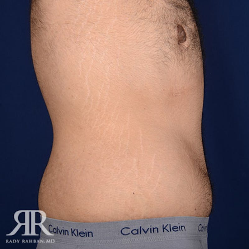 Body Lift Before & After Gallery - Patient 190939 - Image 6