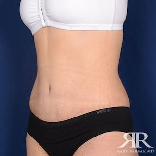 Tummy Tuck Before & After Gallery - Patient 209616 - Image 4