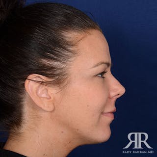 Chin Augmentation Before & After Gallery - Patient 319399 - Image 6