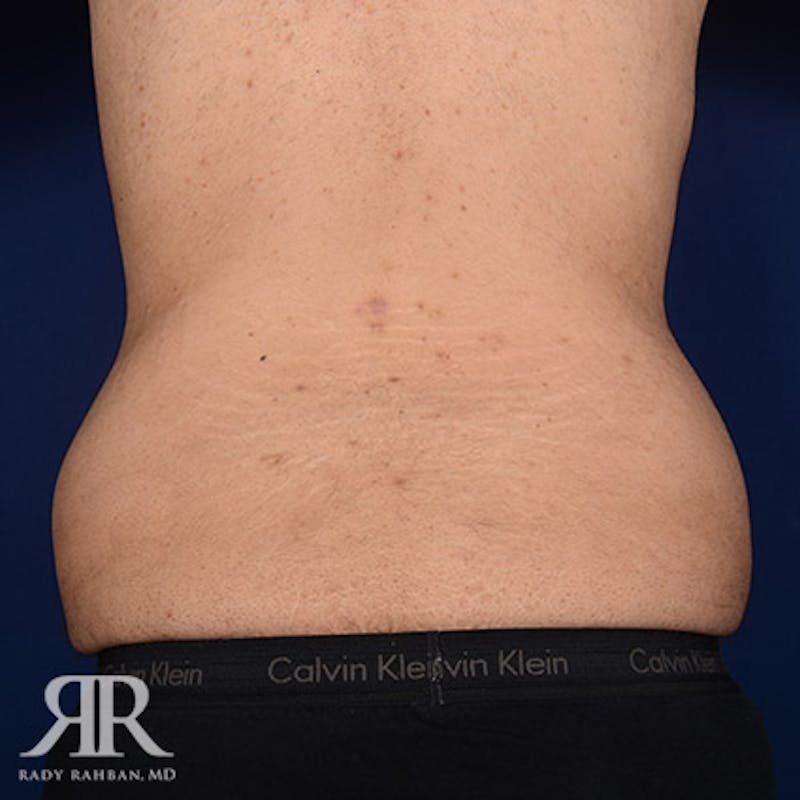 Body Lift Before & After Gallery - Patient 190939 - Image 7