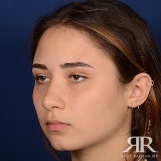 Female Rhinoplasty Before & After Gallery - Patient 350819 - Image 4