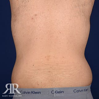 Body Lift Before & After Gallery - Patient 190939 - Image 8