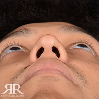 Rhinoplasty w/ Chin Implant Before & After Gallery - Patient 407808 - Image 8