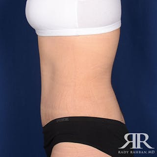 Tummy Tuck Before & After Gallery - Patient 209616 - Image 6