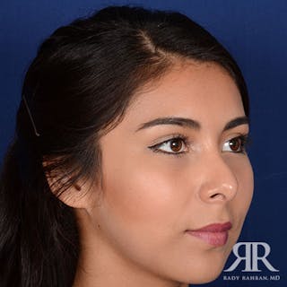 Ethnic Rhinoplasty Before & After Gallery - Patient 365631 - Image 4