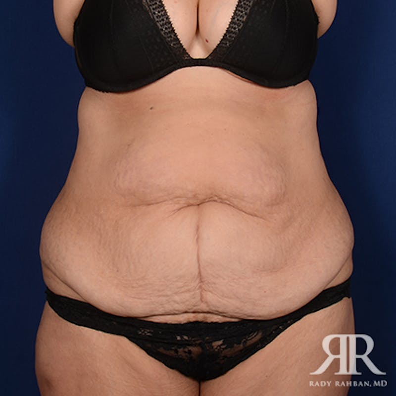 Body Lift Before & After Gallery - Patient 304156 - Image 1