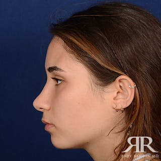 Female Rhinoplasty Before & After Gallery - Patient 350819 - Image 6