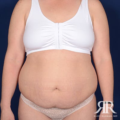 Tummy Tuck Before & After Gallery - Patient 261791 - Image 1