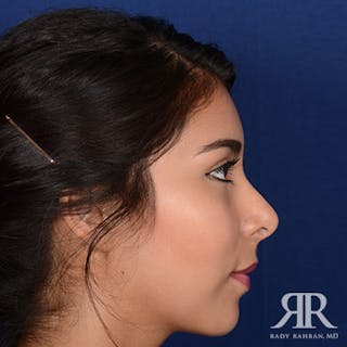 Ethnic Rhinoplasty Before & After Gallery - Patient 365631 - Image 6