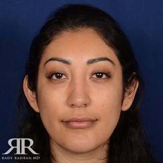 Rhinoplasty w/ Chin Implant Before & After Gallery - Patient 309685 - Image 2