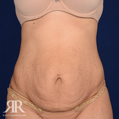 Severe Diastasis Recti Before & After Gallery - Patient 410077 - Image 1