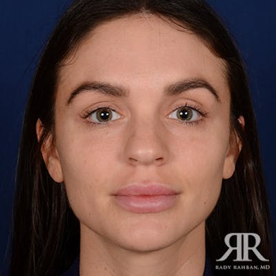 Female Rhinoplasty Before & After Gallery - Patient 105996 - Image 1