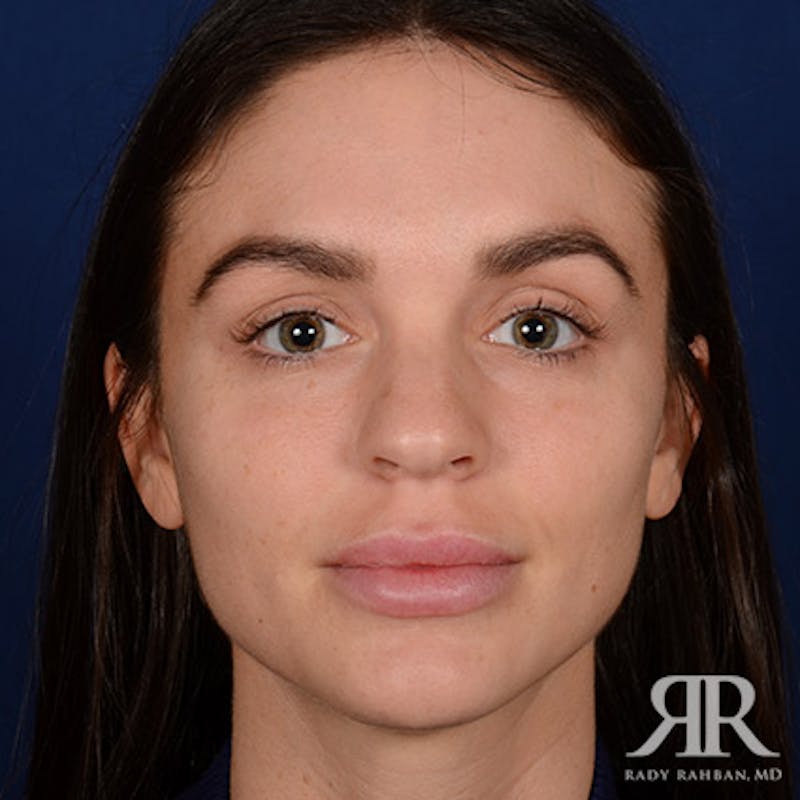 Female Rhinoplasty Before & After Gallery - Patient 105996 - Image 1