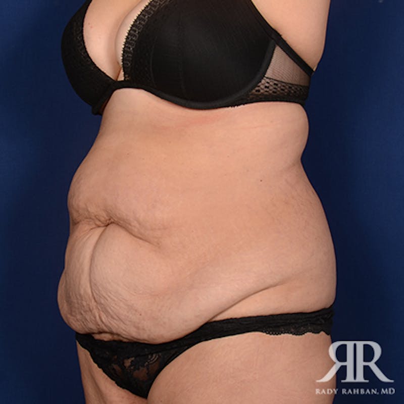 Body Lift Before & After Gallery - Patient 304156 - Image 3