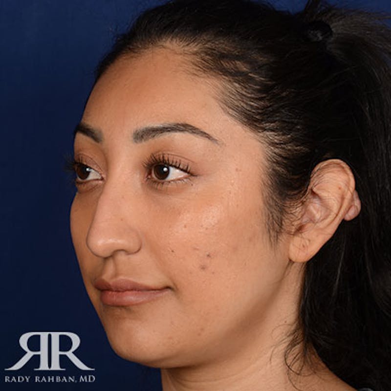 Rhinoplasty w/ Chin Implant Before & After Gallery - Patient 309685 - Image 3