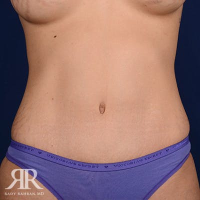 Severe Diastasis Recti Before & After Gallery - Patient 410077 - Image 2