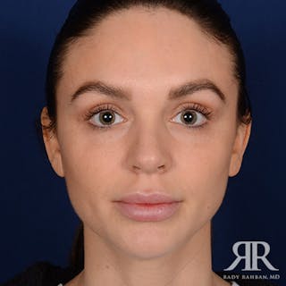 Female Rhinoplasty Before & After Gallery - Patient 105996 - Image 2