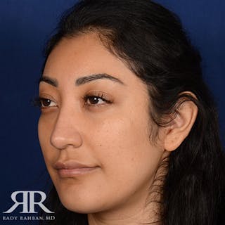 Rhinoplasty w/ Chin Implant Before & After Gallery - Patient 309685 - Image 4