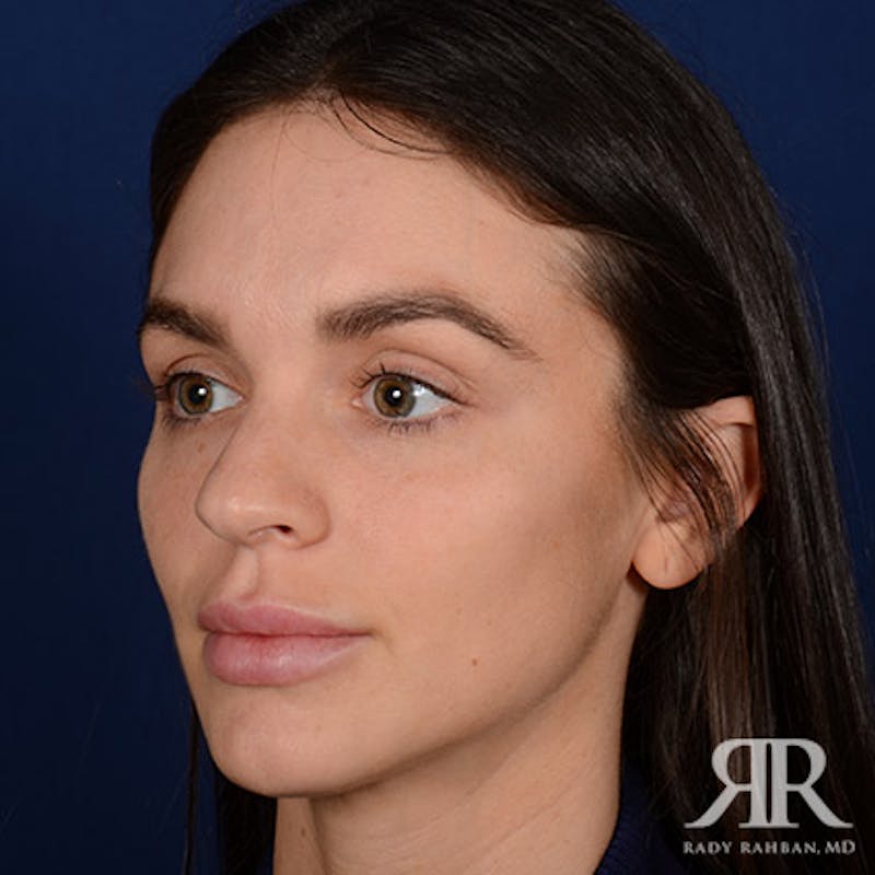 Female Rhinoplasty Before & After Gallery - Patient 105996 - Image 3