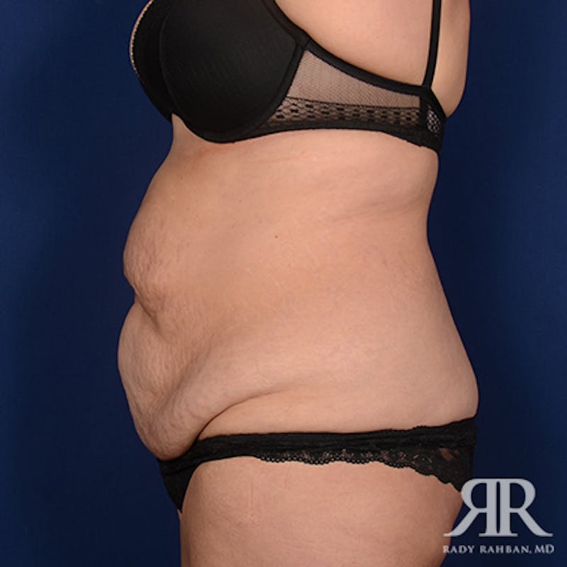 Body Lift Before & After Gallery - Patient 304156 - Image 5