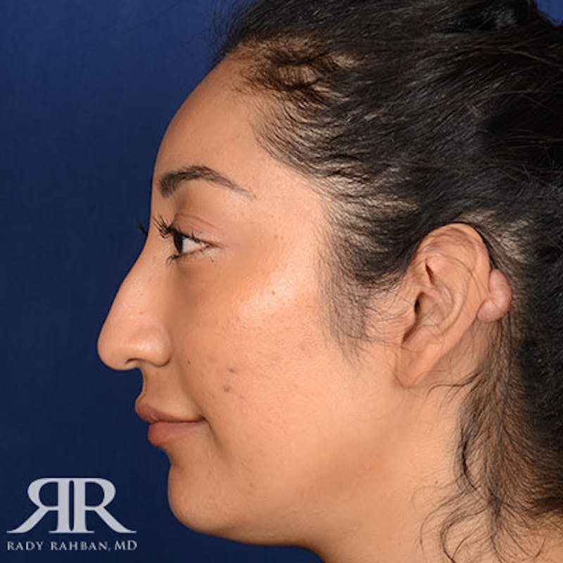 Rhinoplasty w/ Chin Implant Before & After Gallery - Patient 309685 - Image 5