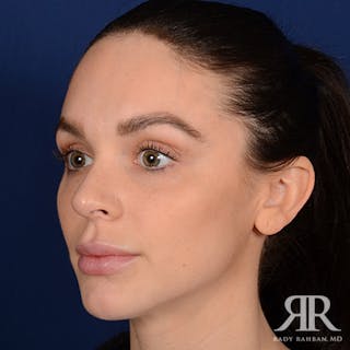 Female Rhinoplasty Before & After Gallery - Patient 105996 - Image 4
