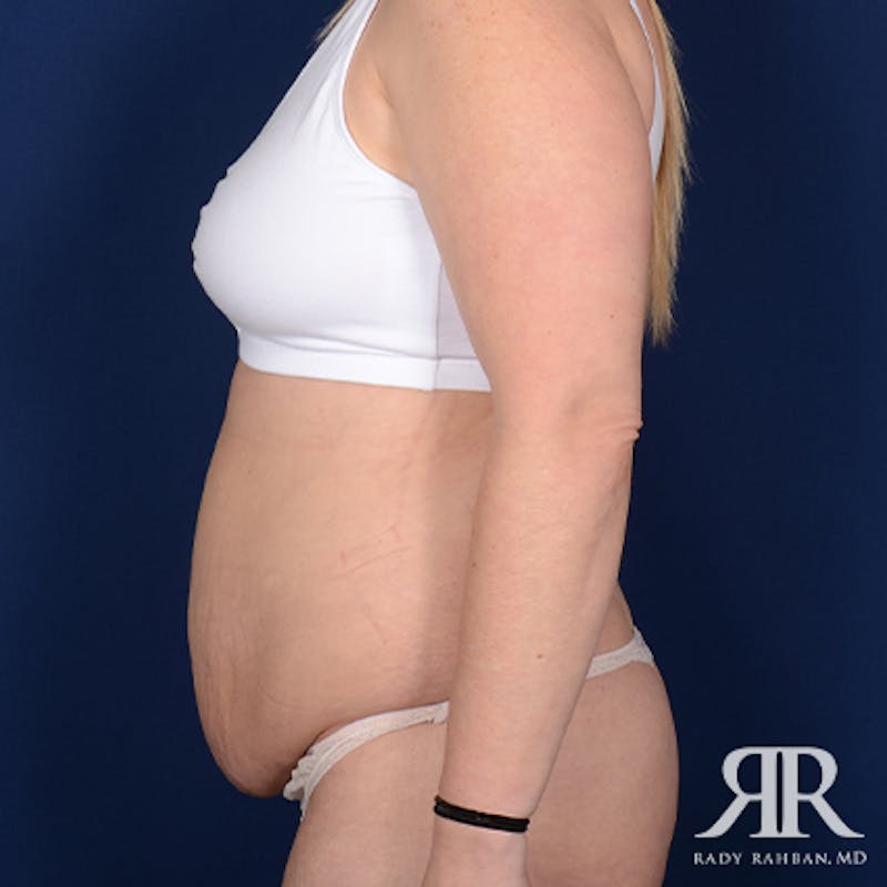 Tummy Tuck Before & After Gallery - Patient 261791 - Image 5