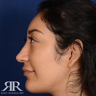 Rhinoplasty w/ Chin Implant Before & After Gallery - Patient 309685 - Image 6