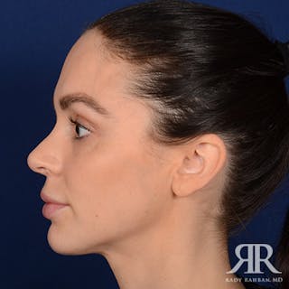 Female Rhinoplasty Before & After Gallery - Patient 105996 - Image 6