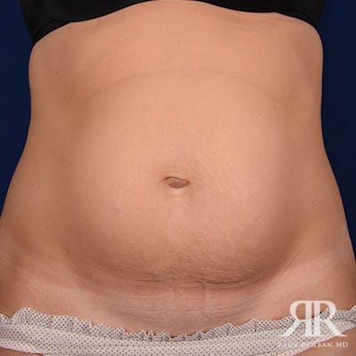 Severe Diastasis Recti Before & After Gallery - Patient 677113 - Image 1