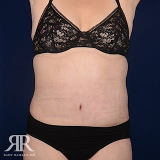 Body Lift Before & After Gallery - Patient 420143 - Image 2