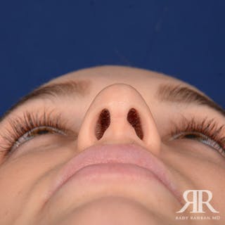 Female Rhinoplasty Before & After Gallery - Patient 105996 - Image 8